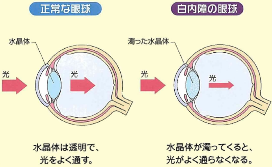 白内障シュミレーション