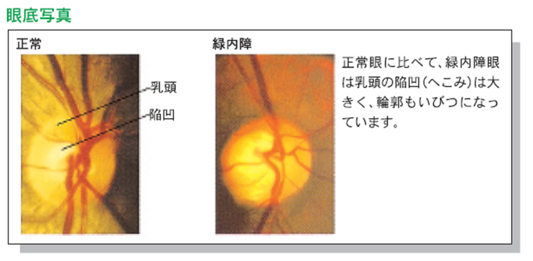 緑内障シュミレーション