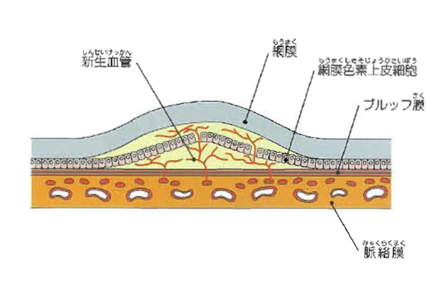 加齢黄斑変性・滲出型